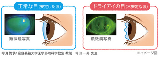 図５．正常な目とドライアイの目